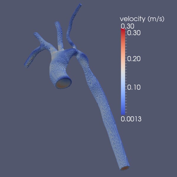 Preview for A Lattice Boltzmann Simulation of Hemodynamics in a Patient-specific Aortic Coarctation Model